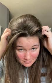 Recovering from rotator cuff surgery