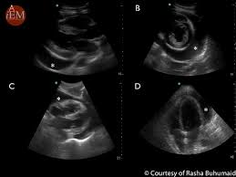 An article on the benefits of multiorgan ultrasound in shock patients. Pocus Rush Protocol International Emergency Medicine Education Project