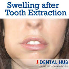 Your dentist will tell you if it's normal and maybe give. 79 Wisdom Teeth Removal Ideas Wisdom Teeth Removal Wisdom Teeth Wisdom Teeth Recovery