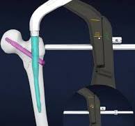 Distal tibial nail is a new technology for distal tibial ...