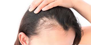 Alopecia totalis — total loss of the hair on the scalp. Alopecia Treatment Market Size Share Growth Focusing On Top Key Players Johnson And Johnson Histogen Aclaris Therapeutics Concert Pharmaceuticals Hcell Cipla Medgadget