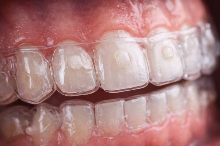 Invisalign Treatment product image
