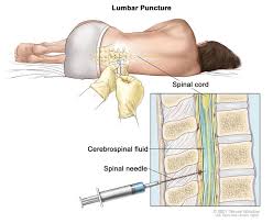 In adults, bacterial meningitis predominates, caused by the bacteria streptococcus pneumoniae and neisseria meningitis. Cancerhelp Online Nci Cancer Diagnosis And Treatment