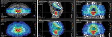 These include your blood pressure, heart rate and metab. Proton Therapy Case Study Prostate Cancer Johns Hopkins Medicine