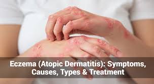 Image result for Atopic eczema atopic dermatitis