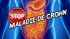 Check spelling or type a new query. Comment Se Sortir De La Maladie De Crohn Bmoove