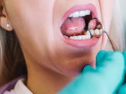 Image result for gums cancer symptoms