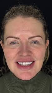 Another amazing transformation using #Nanofillcompositebonding , These  cases may look straightforward. But this is only the case if your chosen  dentist has this skill set literally ingrained in their ...