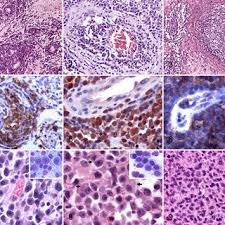 Lymphoma in dogs is an aggressive cancer that can metastasize very quickly. Feline Cutaneous Lymphoma Figure 1 Diffuse Anaplastic Large B Cell Download Scientific Diagram