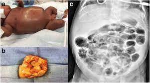 Neonatal Intestinal Dysbiosis In Necrotizing Enterocolitis Molecular Medicine Full Text