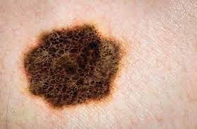 malignant melanoma) genannt, ist ein hochgradig bösartiger tumor der pigmentzellen (melanozyten). Malignes Melanom Schwarzer Hautkrebs Gesund Co At