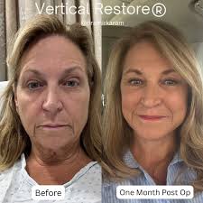 This is 60! 🎂 I wanted to highlight this unbelievable transformation and  take the opportunity to wish my beautiful patient a happy birthday!