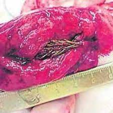 Tree Found Growing In Man S Lung