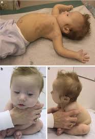 Image result for Floppy Infant