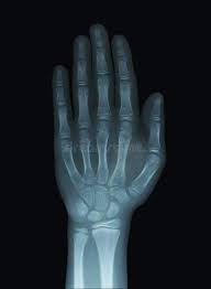 Image result for Hand Growth Plates