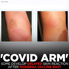 The new england journal of. Eyewitness News On Twitter Some People Who Have Received A Dose Of The Moderna Covid 19 Vaccine Are Having A Delayed Reaction That Causes A Red And Sometimes Bumpy Rash On The Arm