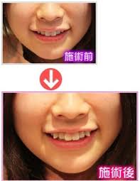 Now i told you there were over a hundred ways to say i. Why Japanese Women Go For Fake Crooked Teeth Japan Today