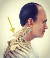 A lump of fat on the back of your neck. Chiropractor For Neck Hump Macquarie Chiro Chiropractor Golden Bay Secret Harbour Mandurah