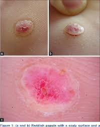 Image result for Leiomyosarcoma