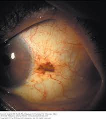 Image result for lesion sclera
