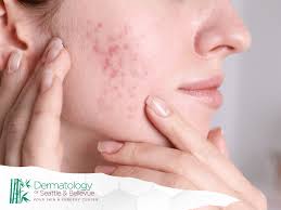 Image result for acne face