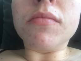 I really like that it makes my skin so soft after i apply it. Clinique Even Better Clinical Dark Spot Corrector Reviews In Anti Aging Serums Prestige Chickadvisor