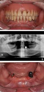 Complete (full) dentures — best for patients who are missing all of their teeth. Digital Immediate Denture A Clinical Report Sciencedirect