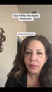 How to Get Rid of Collagen Balls from Agnes