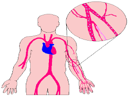 Image result for Decompression Sickness