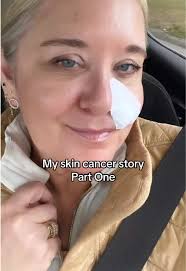 My Skin Cancer Journey: Diagnosed with Basal Cell Carcinoma