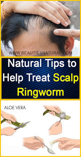 Natural Tips To Help Treat Scalp Ringworm Beauties Natural Ringworm Home Remedies For Ringworm Ringworm Remedies