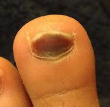 Injury to the nail bed can cause blood to accumulate under the nail, creating a black or dark brown discoloration. Subungual Hematoma Wikipedia