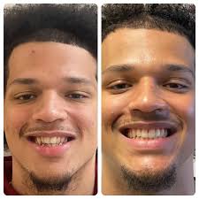 Smile Makeover Gallery Van Nuys, CA