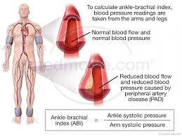 Ankle brachial pressure index (api). Ankle Brachial Index Medmovie Com