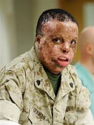 Marine veteran suffers severe burns in Iraq