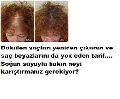 2 Karisimla Dokulen Saclari Geri Kazanin Hair Loss Hair Loss Remedies Women Hair Loss Remedies
