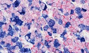 The development of cancerous cells at the back of the mouth, voice box, tonsils, the base of the tongue, sinus and nasal cavities, salivary glands, soft palate and lymph nodes. Proteomics Analysis Ids Potential Drug Targets For Aggressive Cancers Bcm
