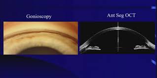 Image result for Gonioscopy