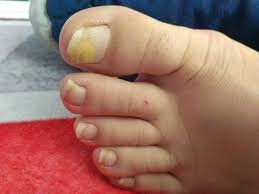 Image result for mykoza nehtů