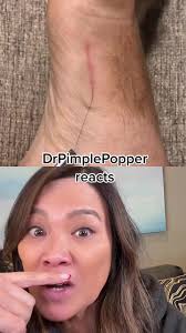 Dr. Pimple Popper Reacts to Cutaneous Larval Migrants