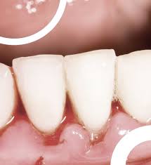 Cette sensation douloureuse peut découler de plusieurs sources, mais si on peut la calmer temporairement, mieux vaut consulter rapidement son dentiste. Abces Dentaire Comment Soigner Cette Infection Des Dents