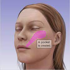 Cheek synonyms, cheek pronunciation, cheek translation, english dictionary definition of cheek. Facial Feminization Surgery Cheek Augmentation Creating High And Feminine Cheekbones 2pass Clinic