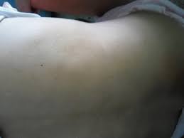 Type Iii Dercum S Disease Edoj 8 2 8