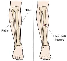 The femur, or thigh bone, is the largest, heaviest, and strongest bone in the human body. Tibia Shinbone Shaft Fractures Orthoinfo Aaos