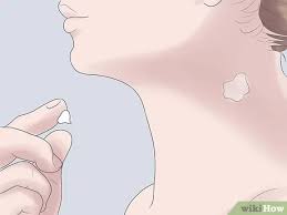 We'll cover exactly what it is and how to remove it. How To Get Rid Of A Hickey Fast 9 Steps With Pictures Wikihow