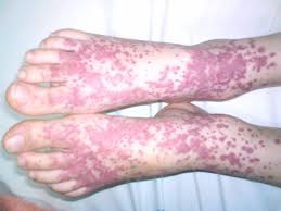 People with henoch's purpura are not affected by joint disease. Henoch Schoenlein Purpura Core Em