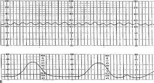Image result for FHR Variability