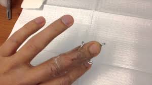 The injury results when an unyielding object (like a ball) strikes the tip of the digit and forces it to bend further than it is intended to go. Broken Finger Pin Removal Youtube