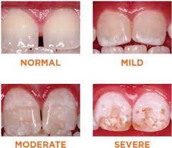 View enamel hypoplasia research papers on academia.edu for free. Enamel Hypoplasia Heights Pediatric Dentistry Orthodontics