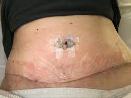 A sauna or a steam room? Tt 3 Weeks Ago Doc Used Steri Strips But Have Severe Skin Itching Need Help With Itching Remove Steri Strips Photo
